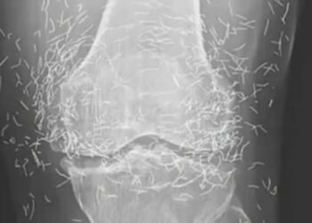 Doctors find “gold mine” in woman’s knees