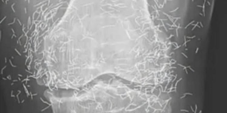 Doctors find “gold mine” in woman’s knees