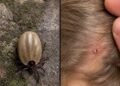 Found a Tick on Your Child? Here’s What Parents Should Do—and What to Watch For