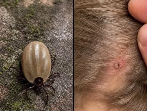 Found a Tick on Your Child? Here’s What Parents Should Do—and What to Watch For
